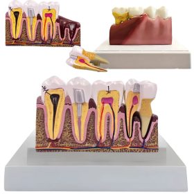   Anatomický model zuba a prierez čeľuste s vyberateľným zubom, 18 × 11 cm